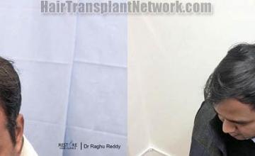 Hair transplantation surgery before and after pictures