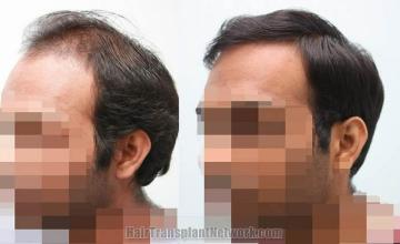 Hair transplantation surgery before and after images