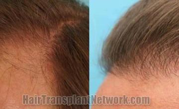 Hair transplantation surgery before and after photos