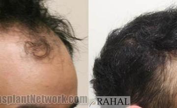 Hair restoration procedure before and after results