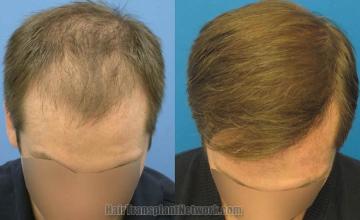 Top view before and after hair restoration results