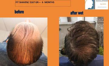 Hair restoration procedure before and after pictures