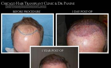 Hair restoration procedure before and after pictures