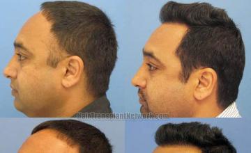 Hair restoration procedure before and after pictures