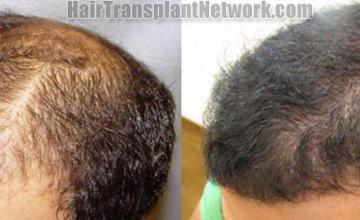Hair transplant photos before and after viewed from the back