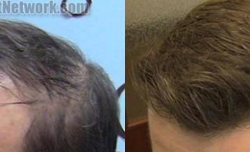 air transplantation surgery before and after pictures