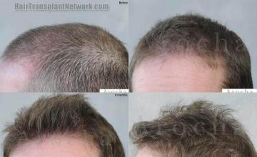 Hair transplantation surgery before and after images