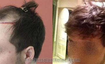 Hair restoration procedure before and after pictures