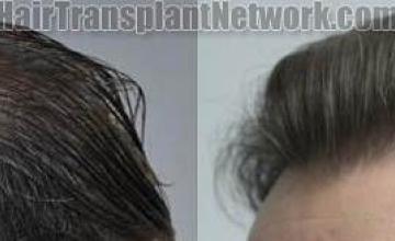 Hair transplantation surgery before and after pictures