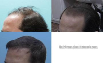 Hair transplantation surgery before and after pictures
