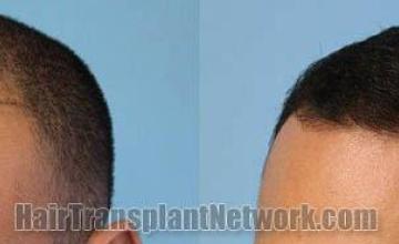 Hair transplantation surgery before and after images