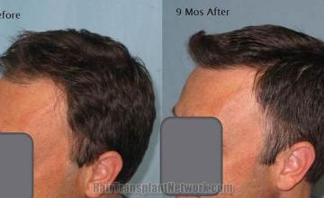 Hair restoration procedure before and after pictures