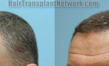Hair transplantation surgery before and after images