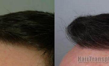 Viewing left side close up photos of hair transplant results