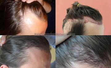 Hair transplantation surgery before and after images