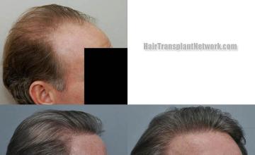 Hair transplantation surgery before and after pictures