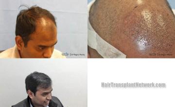 Hair transplantation surgery before and after images