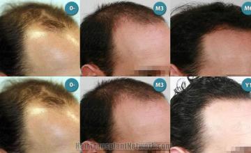 Hair transplantation surgery before and after images