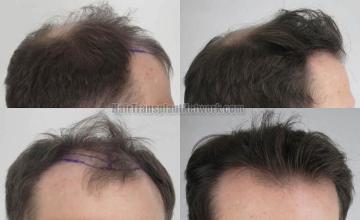 Hair transplantation surgery before and after images