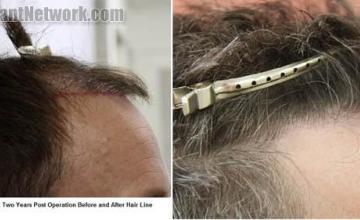 Hair transplantation surgery before and after images