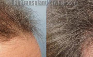 Hair transplantation surgery before and after photos