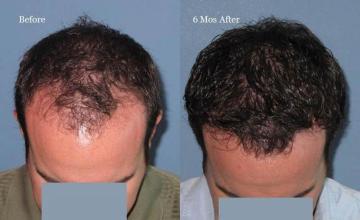 Hair transplantation surgery before and after photos