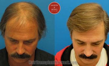 Hair restoration surgery before and after photos