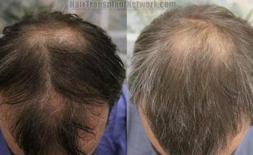 Hair restoration pictures - Top view