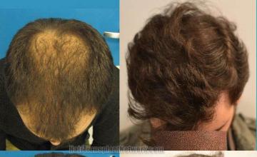 Top view - Before and after surgical hair replacement