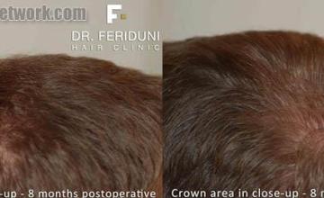 Hair replacement surgery before and after photographs