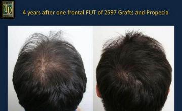 Back / Crown views of before and after hair transplant