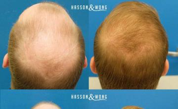 Hair transplantation surgery before and after images