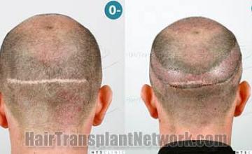 Surgical hair transplantation result photographs