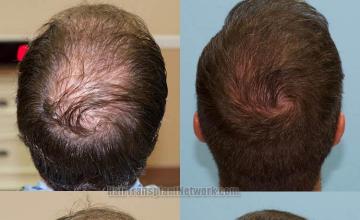 Hair replacement surgery before and after images