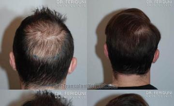 Hair transplantation procedure before and after photographs