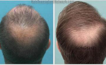 Hair transplantation procedure before and after photo results