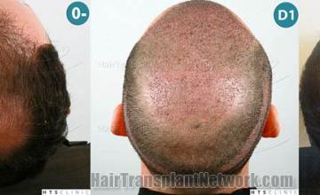 Hair restoration procedure before and after pictures