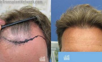 Hair restoration procedure before and after results