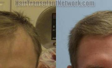 Front view - Before and after  