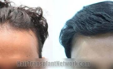 Front view - Before and after hair transplant surgery result images