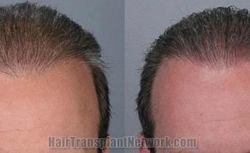 Front view - Before and after