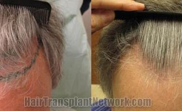 Before and after hair transplant procedure images