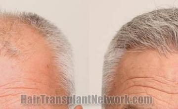 Front view - Before and after