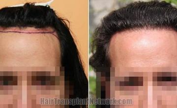 Front view - Before and after