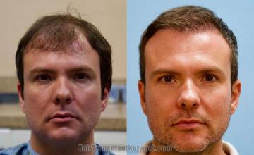 Front view - Before and after hair restoration procedure