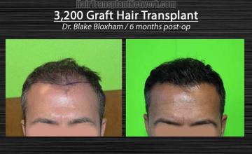 Hair restoration procedure before and after pictures