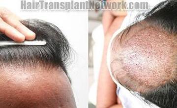 Hair replacement surgery before and after images