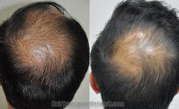 Hair restoration procedure before and after pictures