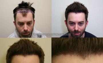 Front view - Before and after hair transplantation