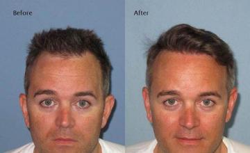 Front view - Before and after